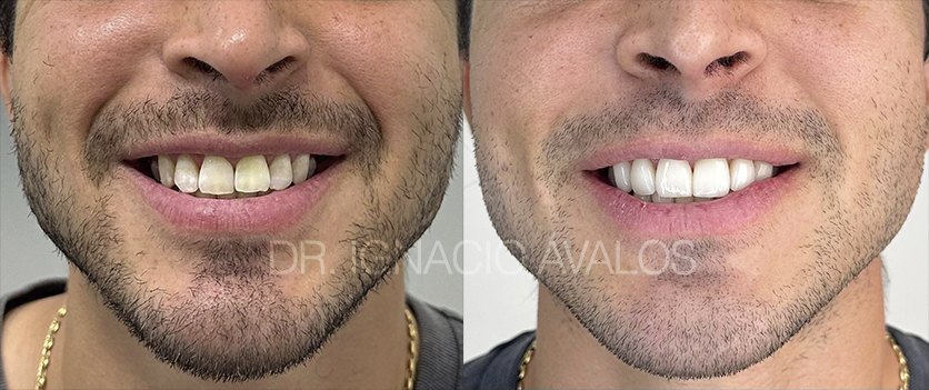 Transformación de sonrisa - Caso 3