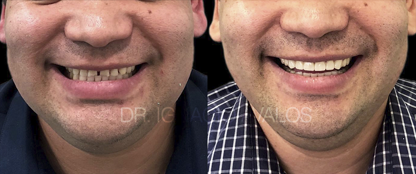 Transformación de sonrisa - Caso 4