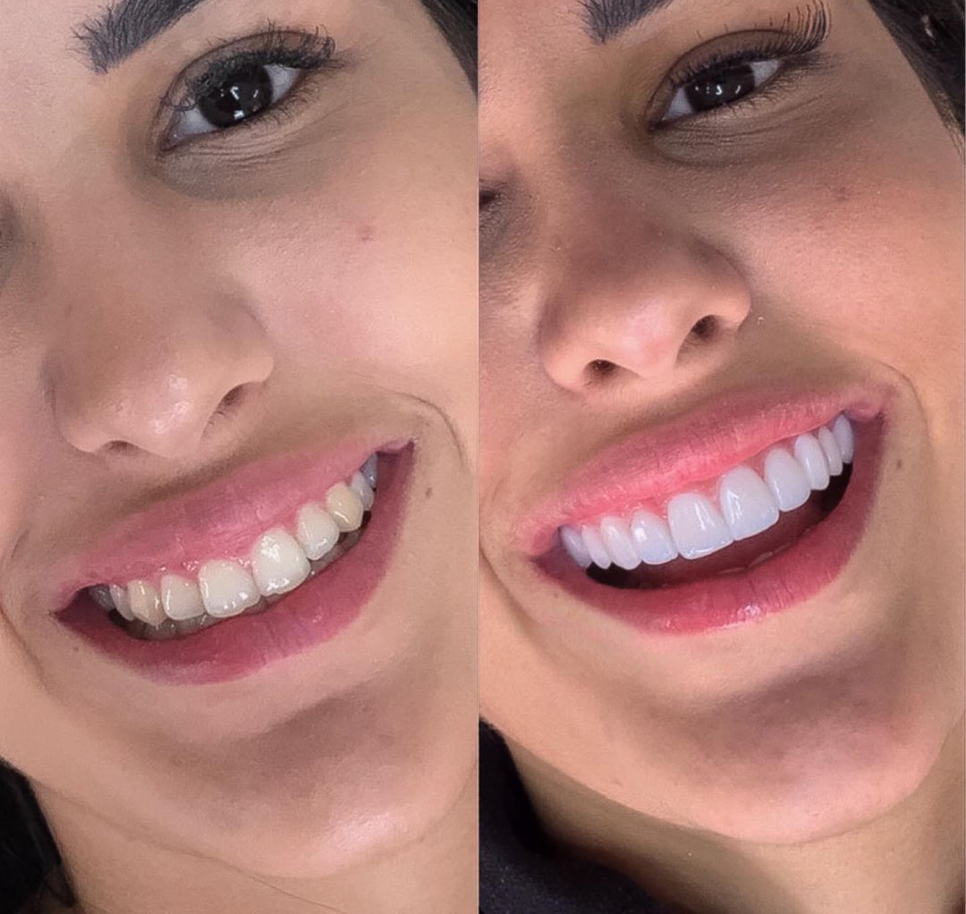 Transformación de sonrisa - Caso 1