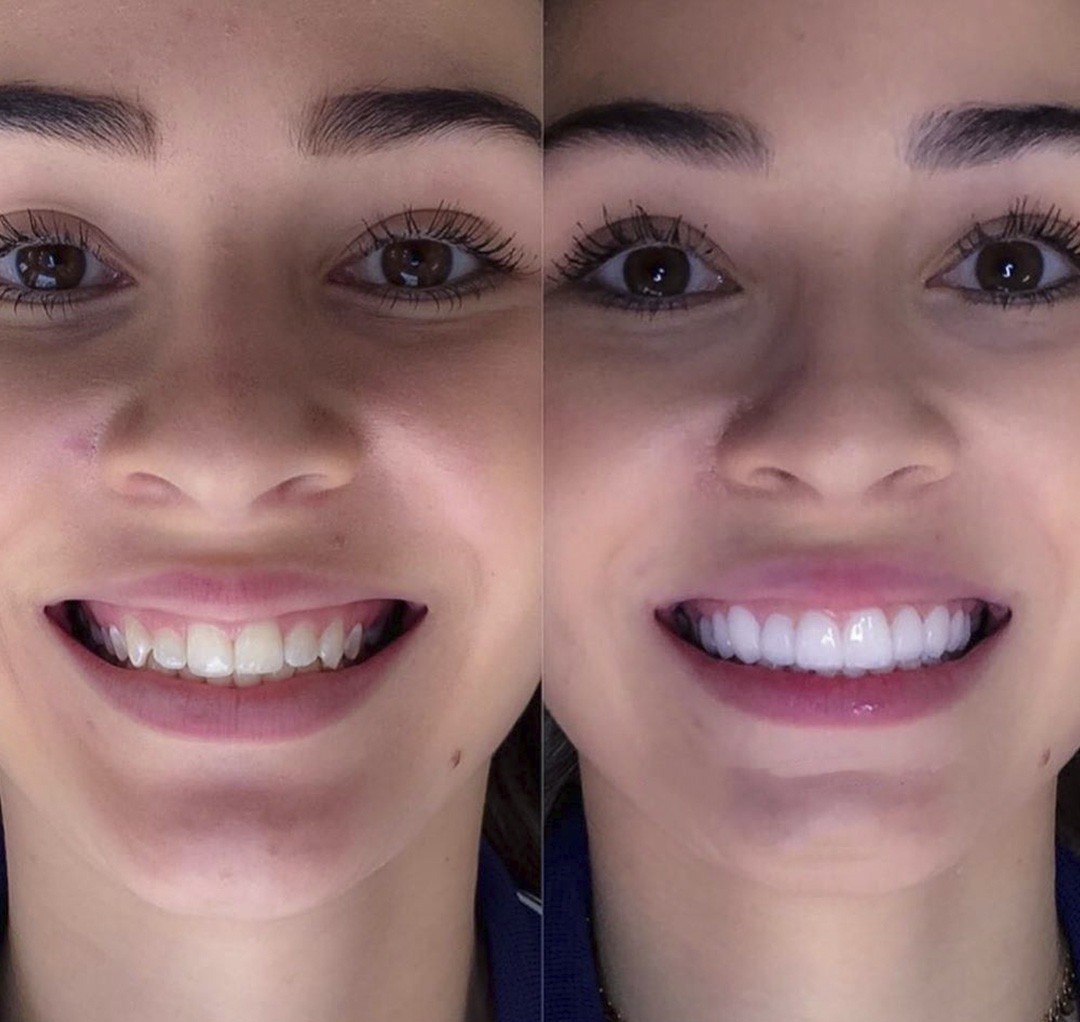 Transformación de sonrisa - Caso 2